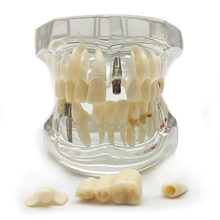 Orthodontic Dental Pathological Implant Teeth Model Study
