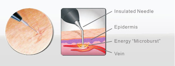 Portable Vacular Spider Vein Removal Machine ， RBS 30Mhz High Frequency