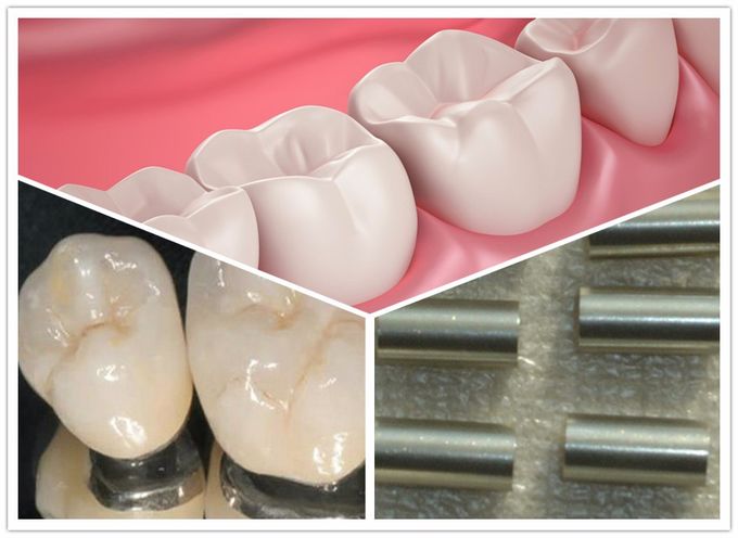 中国の新素材ステライトコバルトクロム歯科用合金