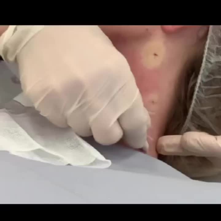 Reborn PLLA dermal filler for neck treatment