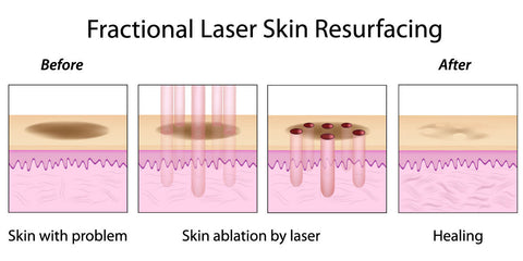 fractional laser skin resurfacing