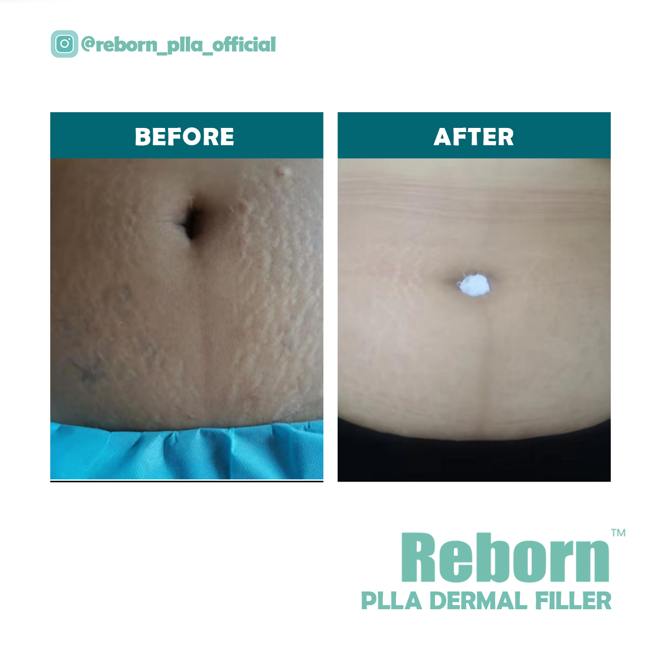 Reborn PLLA Dermal Filler para estrias