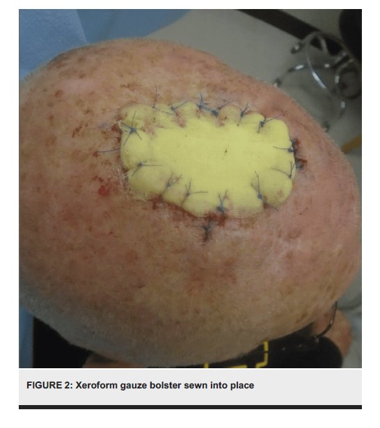 Xeroform Gauze Bolster: A Cost-Effective  Alternative to Synthetic Skin Grafts 