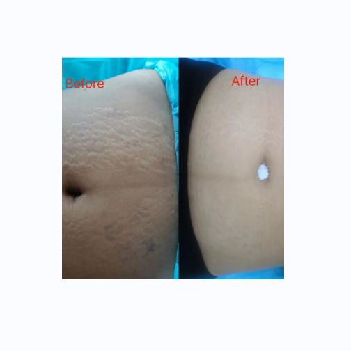 Rimless Belly Wrinkles Filler