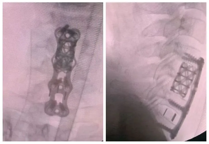 Anterior cervical fracture surgery