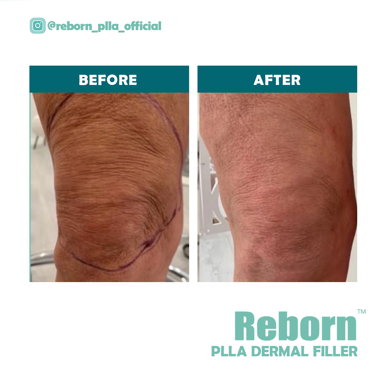 Αναγεννημένη Plla Dermal Filler για θεραπεία στο γόνατο