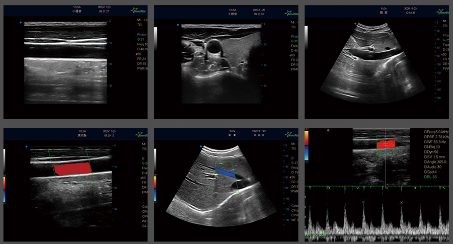 Portable color Doppler ultrasound