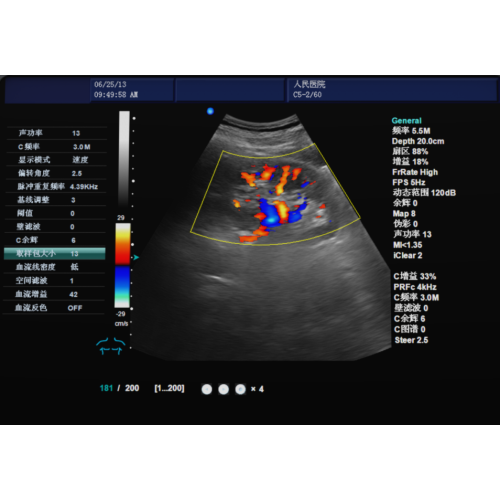 What is color Doppler ultrasound?