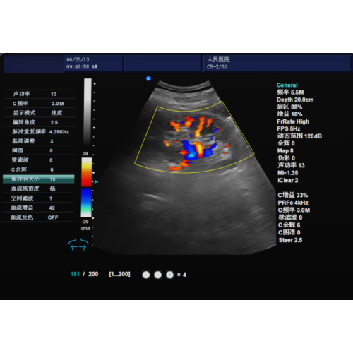 Was ist der Farbdoppler -Ultraschall?