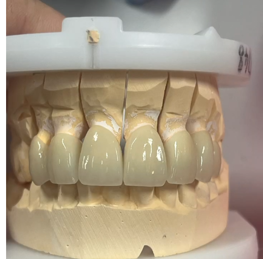 Layered Ziconia(PFZ) 6 anterior crowns with high translucency