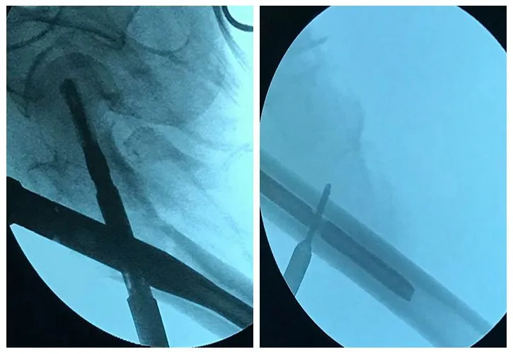 PFNA interlocking nail surgery