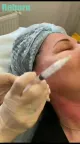 Reborn PLLA Dermal Fillers Treatment