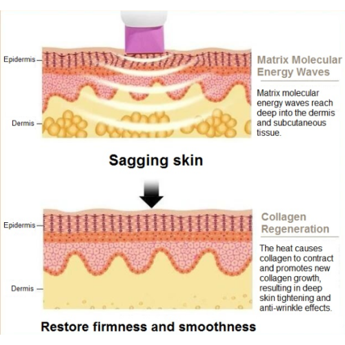 The differences between HIFU and Thermage | Choicy Beauty- a beauty training academy