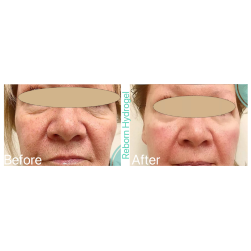 Reborn PLLA Hydrogel Filler for Mesotherapy