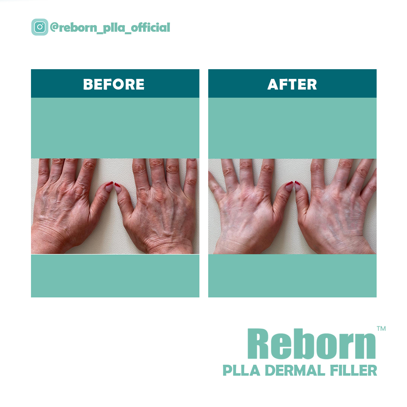 Reborn PLLA Dermal Filler para tratamento Hands