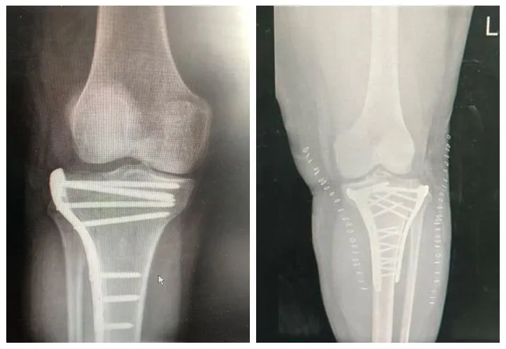 Proximal tibial fracture surgery