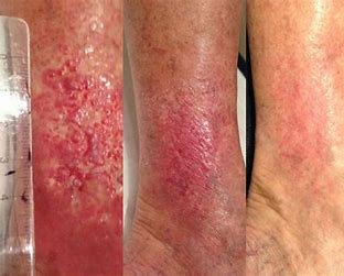 Comparison of two dressings in the treatment of venous leg ulcers