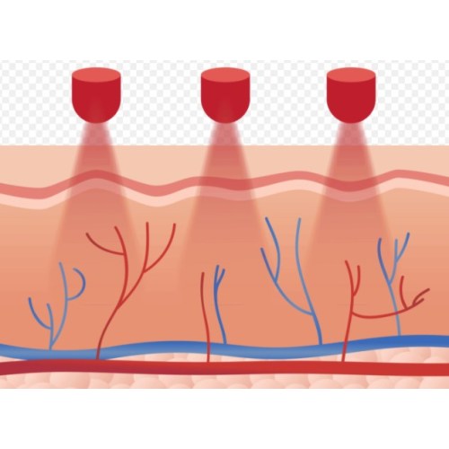 ¿Qué es la terapia de luz roja?