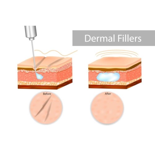 Injectable Dermal Fillers Not Only Fill, but Lift!