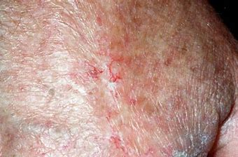 Prevention and treatment of radiodermatitis using a non-adhesive foam dressing