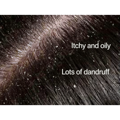 Прощай, зуд: средство от перхоти и зуда