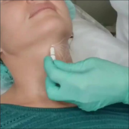 Injectable PLLA Dermal Filler Bebore and After