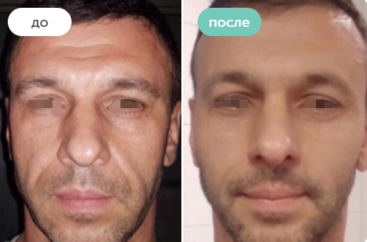 FACE REJUSULAÇÃO-NABIXO PLLA DERMAL FILLADOR