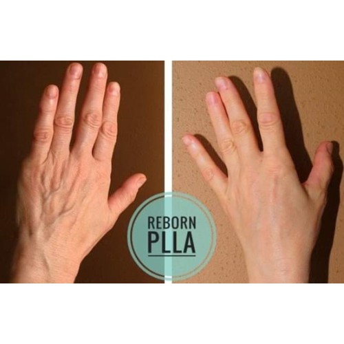 What Is Hand Rejuvenation?