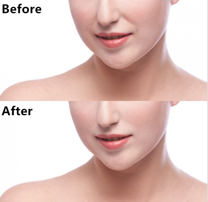 Restylane 1ml гиалуроновая кислота дермальный наполнитель HA Dermal Filler к анти -морщине на лице 4