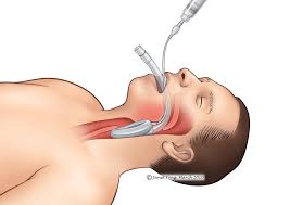 an successful intubation of laryngeal mask airway