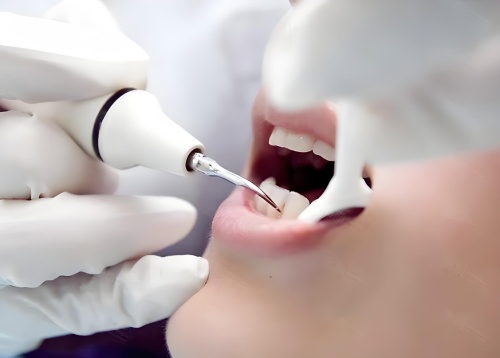 Posso comprar um instrumento para limpar meus dentes em casa?