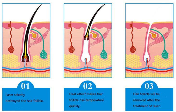 Diode Laser Hair Removal Beauty Equipment