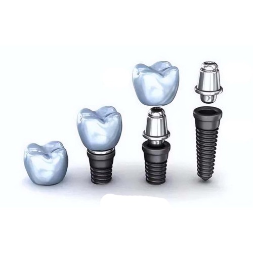 Why is a dental implant divided into Grade 4 and Grade 5 titanium?