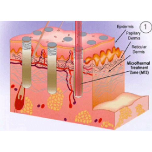 All about CO2 Fractional Laser | Choicy Beauty- a beauty training academy