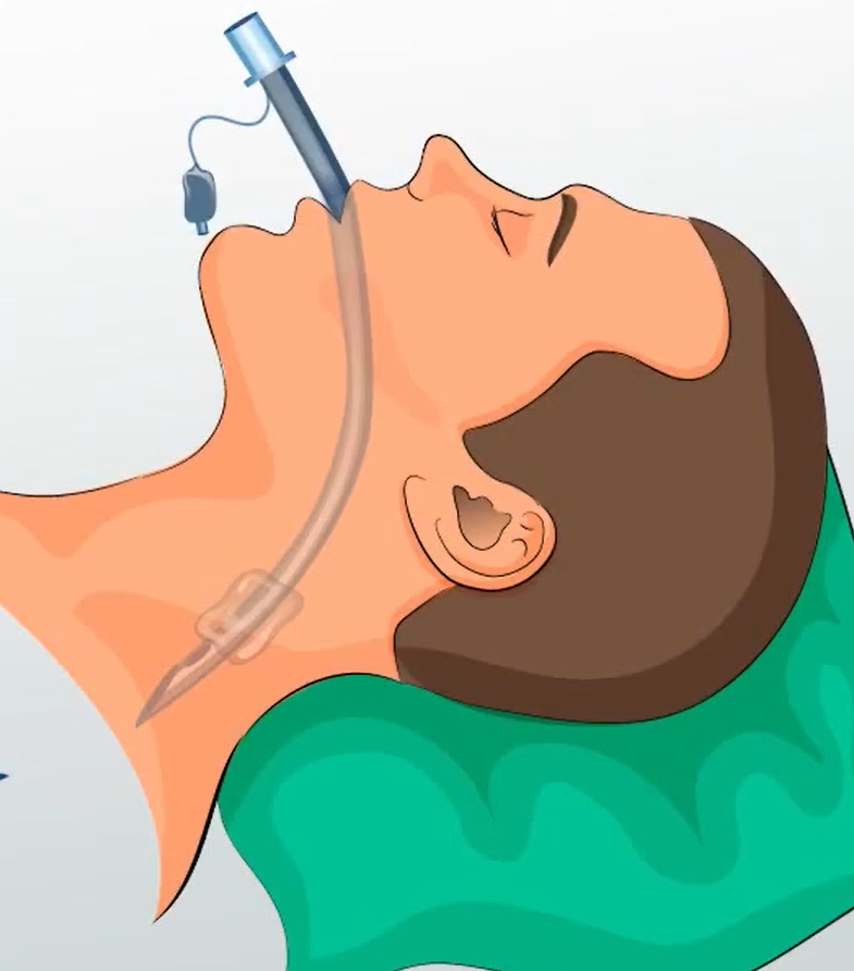 Is the ETT tube cuffs made of PVC?