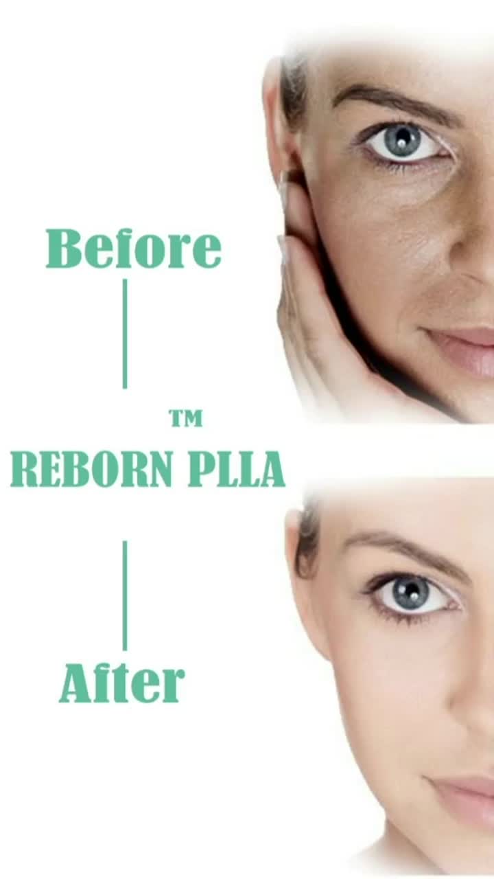 Reborn PLLA Dermal Filler