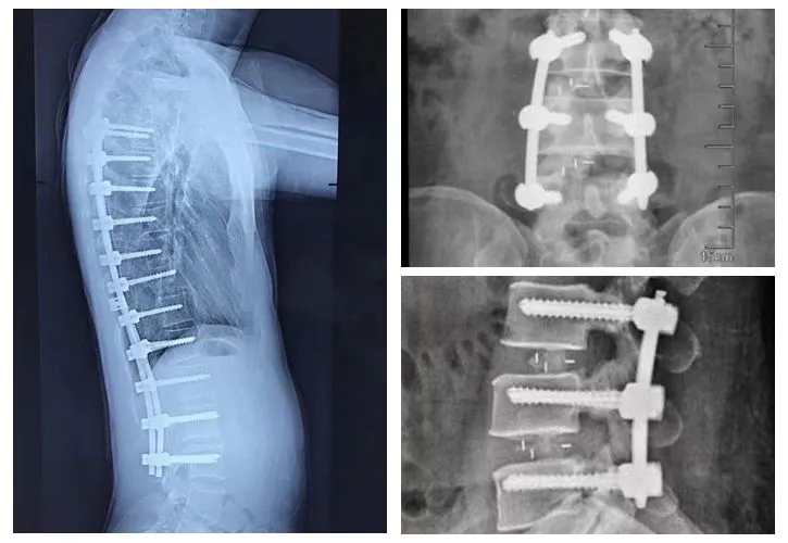 Spinal fixation surgery