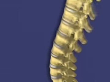 Balloon Kyphoplasty for VCFs
