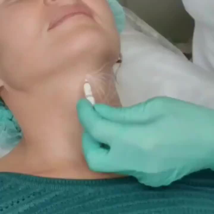 Renacimiento PLLA Dermal Filler para el rejuvenecimiento del cuello