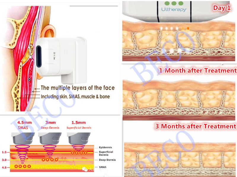 Hihu! Portable Hifu Machine (FU4.5-10S)