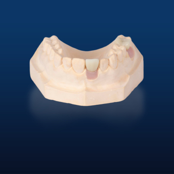 Lithium Disilicate Cad Dental Implant Restoration