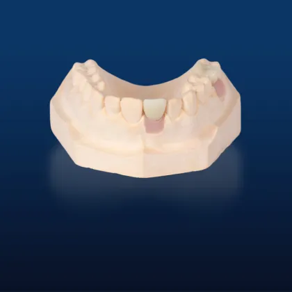 Customized Dental Implant Porcelain