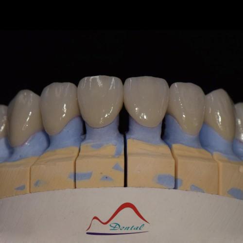 Aesthetics Zirconia Porcelain Bridge