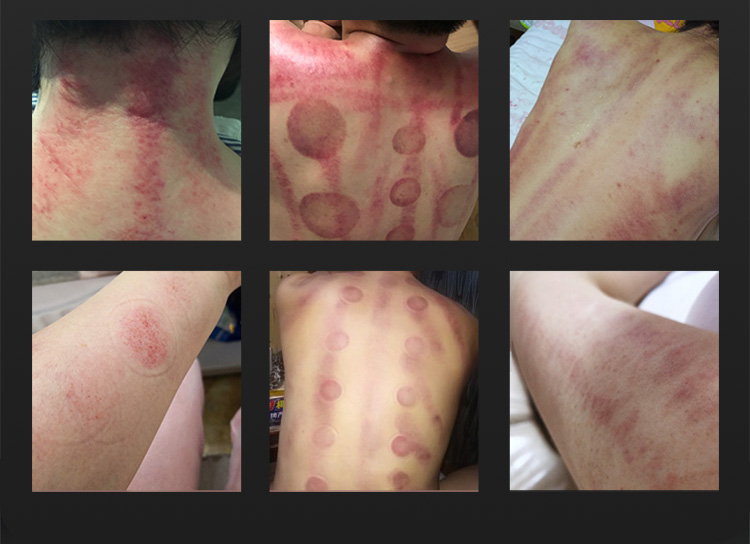 at home cavitation