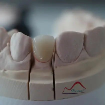 Dental Anterior Zirconia Restoration