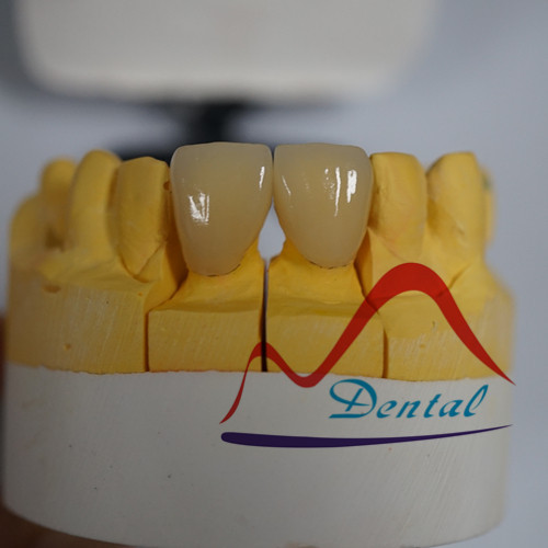 IPS E.max® all Ceramic Crowns