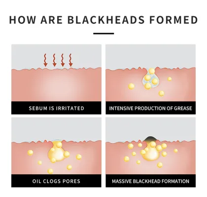 Pore Cleaning Blackhead Removal Stickers