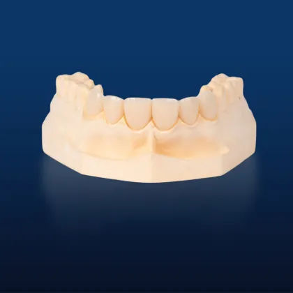 IPS Emax Dental Restorations