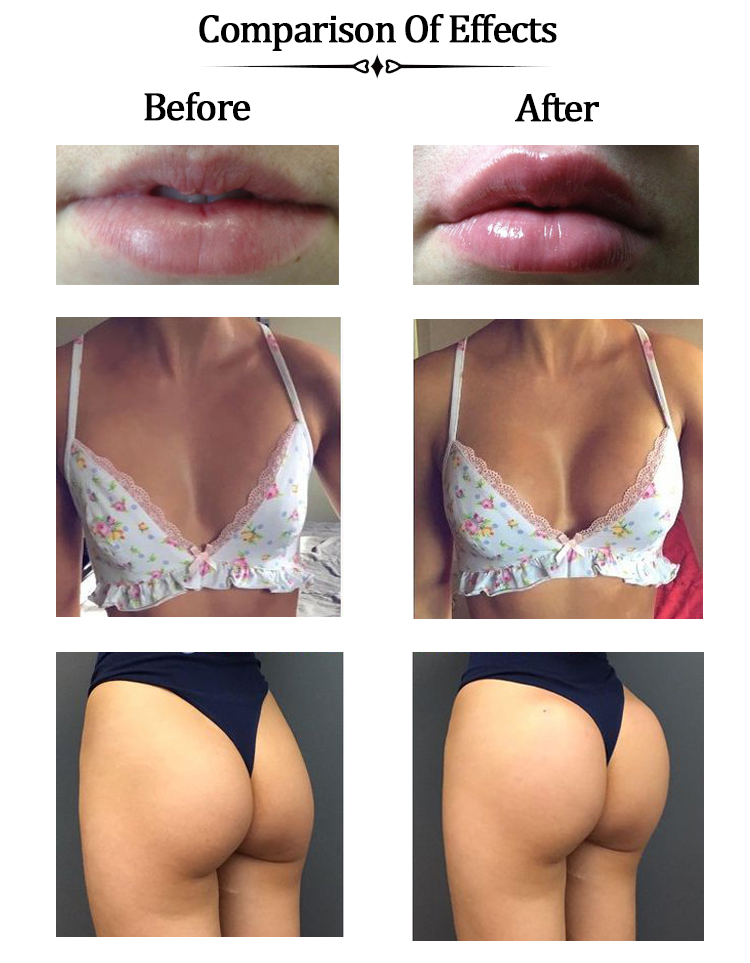 Effect Before And After Breast Enhancement