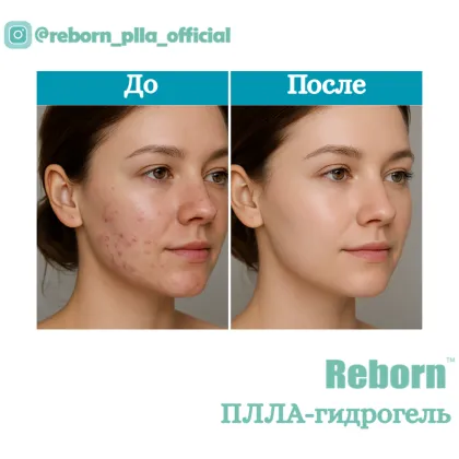 Mesotherapy Products Injection PLLA Hydrogel Filler